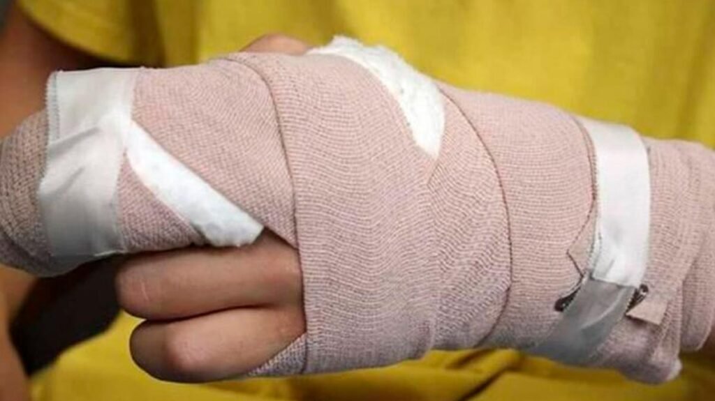 Adulto quemado con pólvora