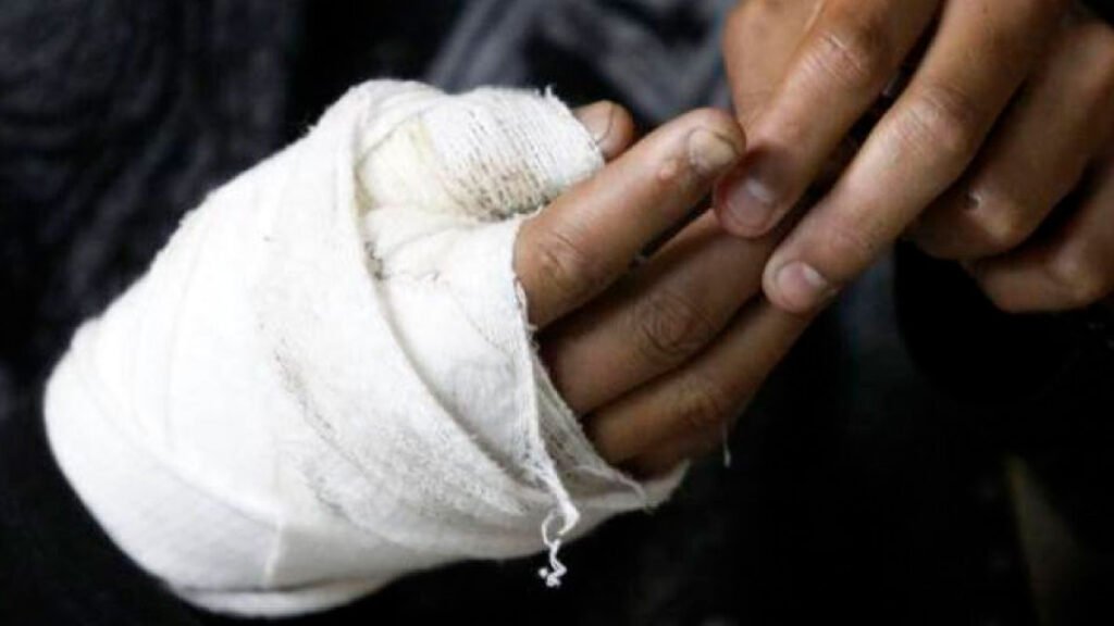 Lesionado con pólvora