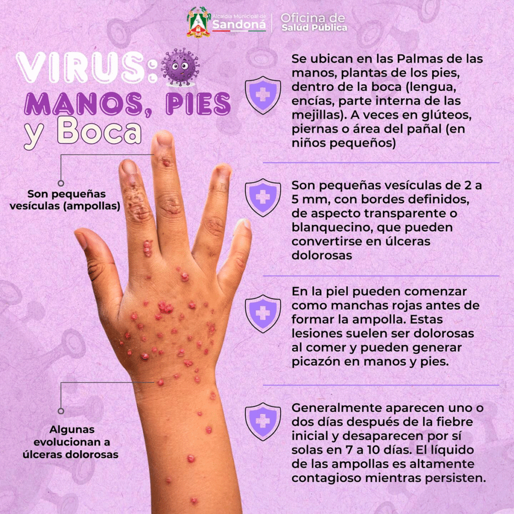 Virus de manos, pies y boca