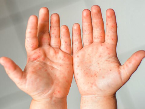 Virus de manos, pies y boca