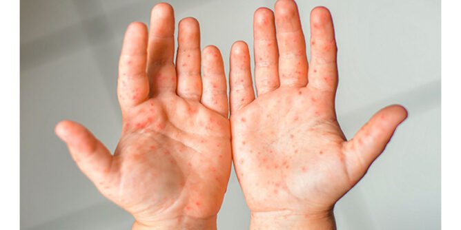 Virus de manos, pies y boca