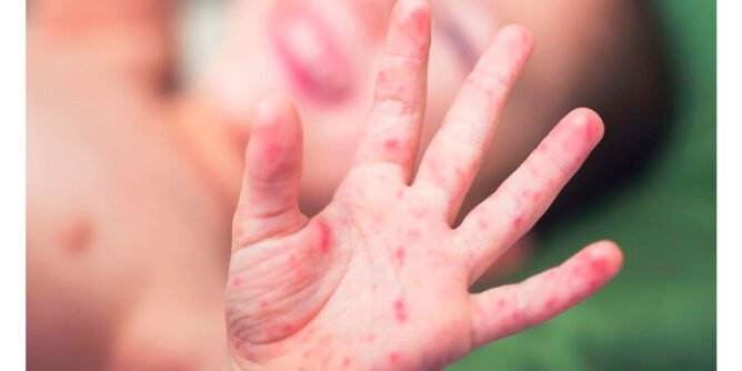 Brote de manos, pies y boca en niños de Nariño