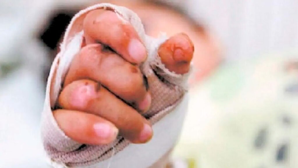 Lesionado por pólvora