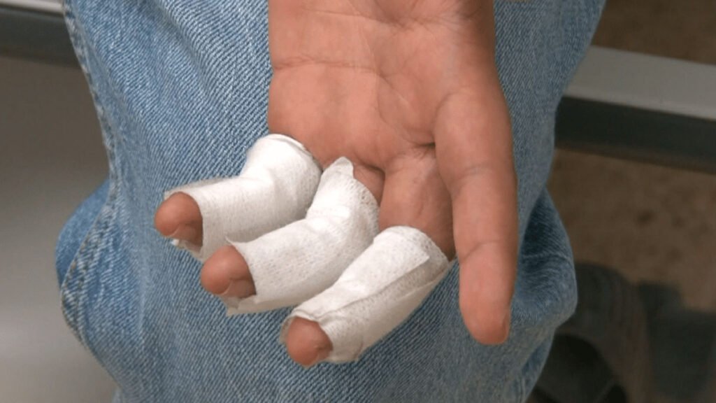 Quemado por pólvora