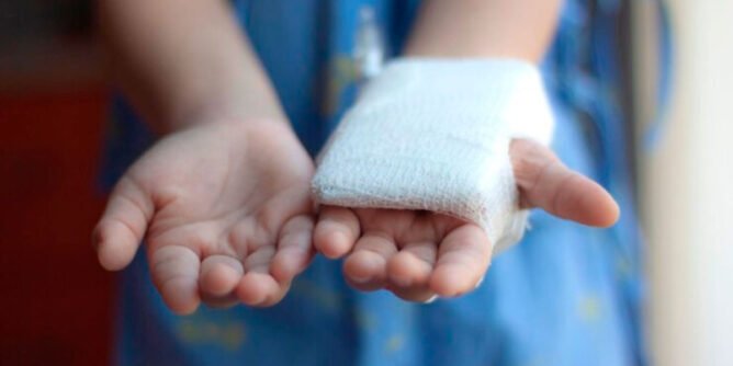 Quemado por pólvora