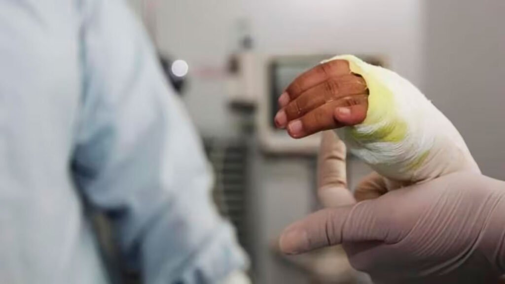 Quemado por pólvora