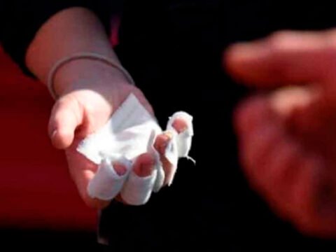 Quemado por pólvora