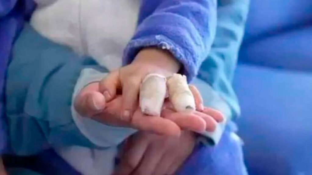 Quemado por pólvora