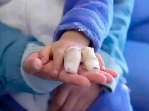 Quemado por pólvora