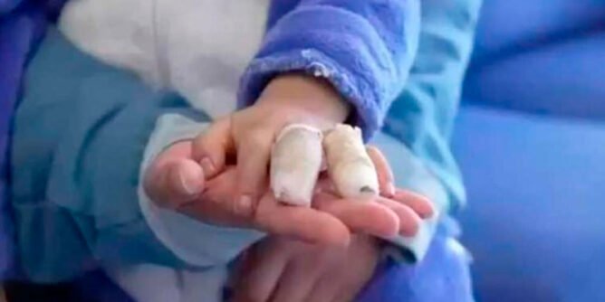 Quemado por pólvora