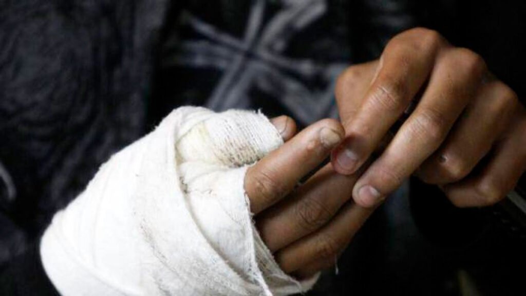 Quemado por pólvora