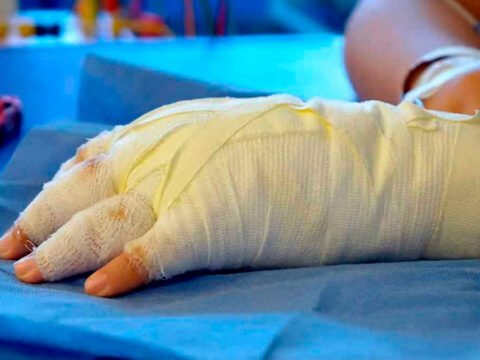 Quemado por pólvora